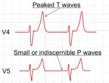 hyperkaliemia